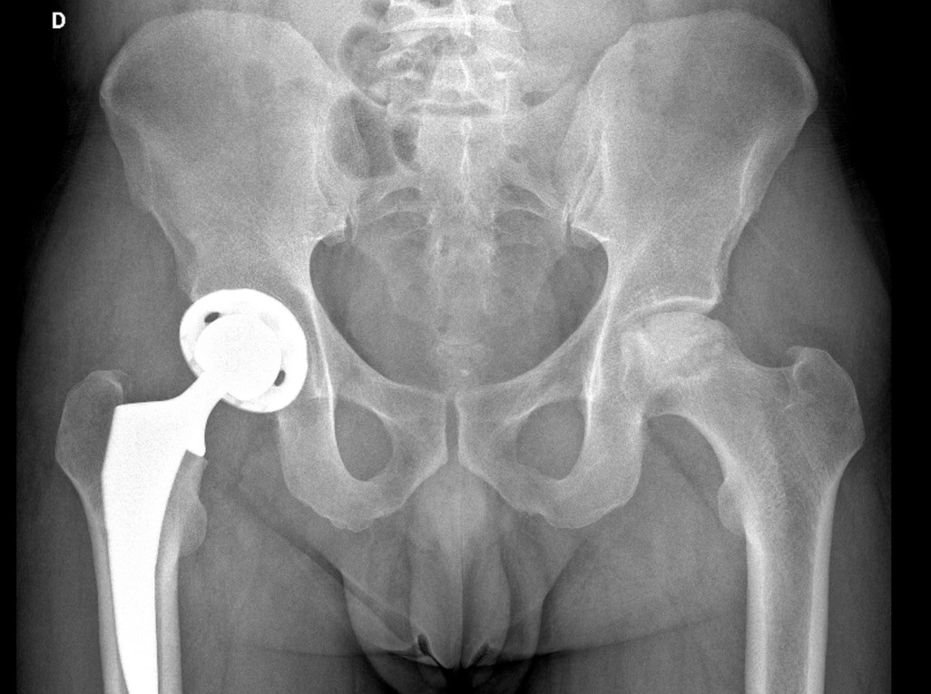 Radiografía anteroposterior de pelvis con una prótesis total de cadera
