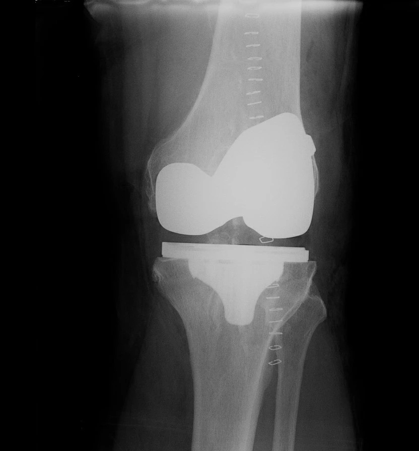 Radiografía anteroposterior de una prótesis total de rodilla