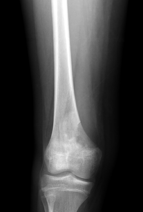 Radiografía de un tumor óseo en el fémur distal