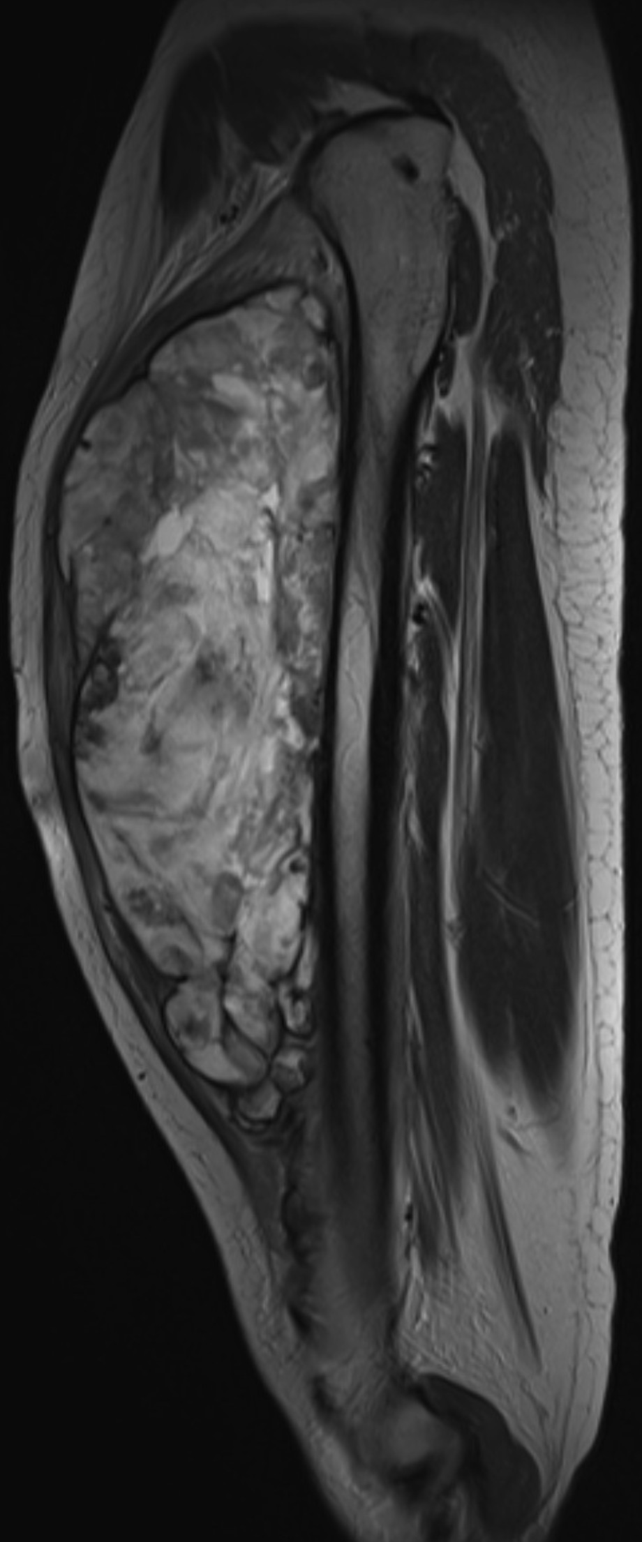 Resonancia magnética de un tumor de partes blandas en el muslo