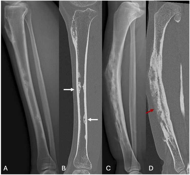 Radiografía y TAC de tibia comparando displasia osteofibrosa (A–B) y adamantinoma (C–D).