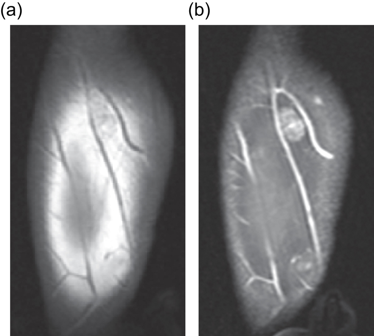 Resonancia de un angiolipoma subcutáneo del antebrazo.