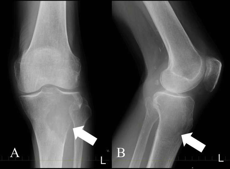 Radiografía de rodilla con un angiosarcoma de la tibia proximal.