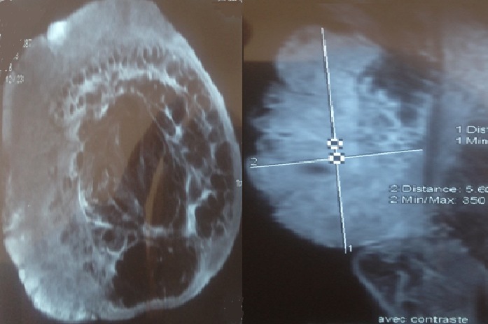Resonancia del antebrazo con un angiosarcoma de partes blandas.