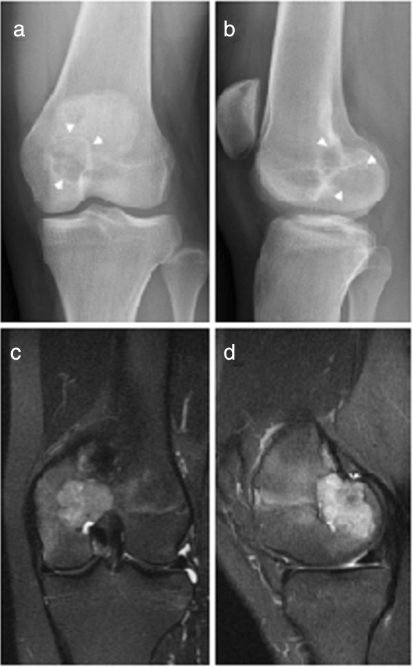Radiografías y resonancia de un condroblastoma en la epífisis distal del fémur.