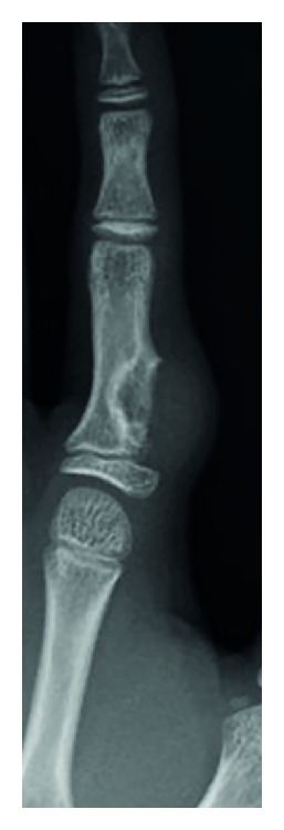 Condroma periostal de un dedo en radiografía