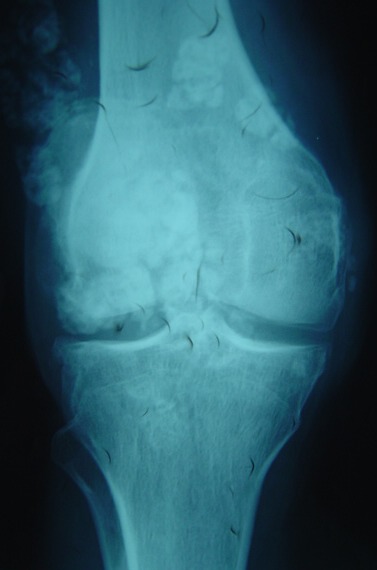 Radiografía de rodilla con condromatosis sinovial.