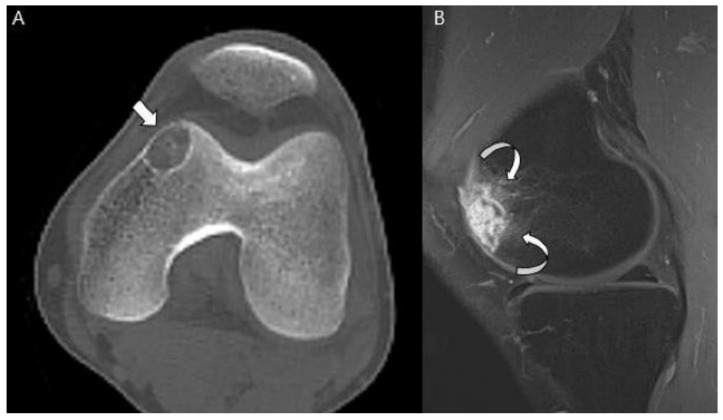 TAC y RM de un condrosarcoma de células claras de la epífisis distal del fémur.