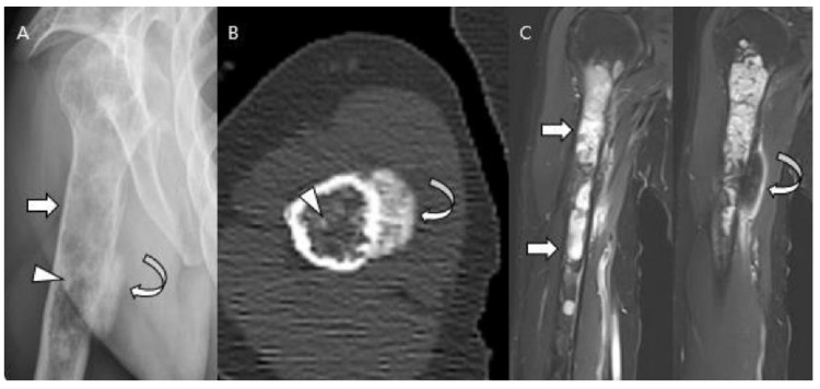 Radiografía, TAC y resonancia de un condrosarcoma desdiferenciado bimórfico.
