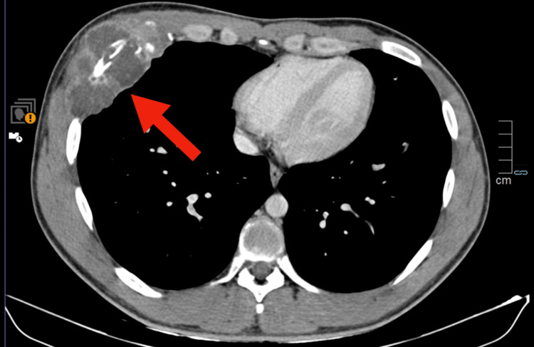 TAC de tórax con un condrosarcoma mesenquimal en una costilla.