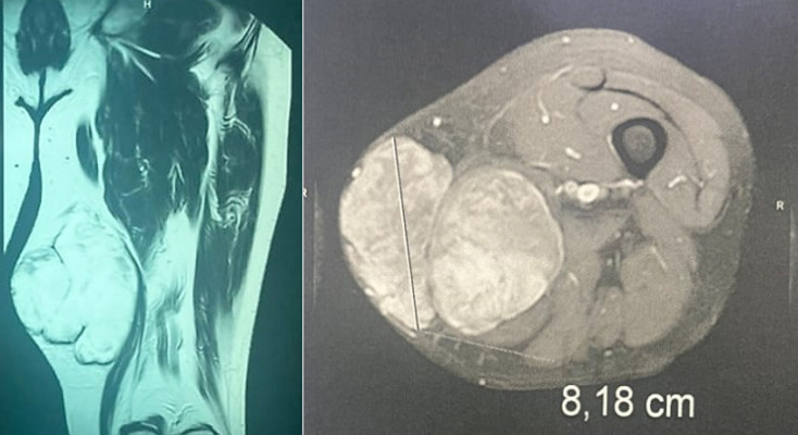 Condrosarcoma mixoide extraesquelético del muslo en RM