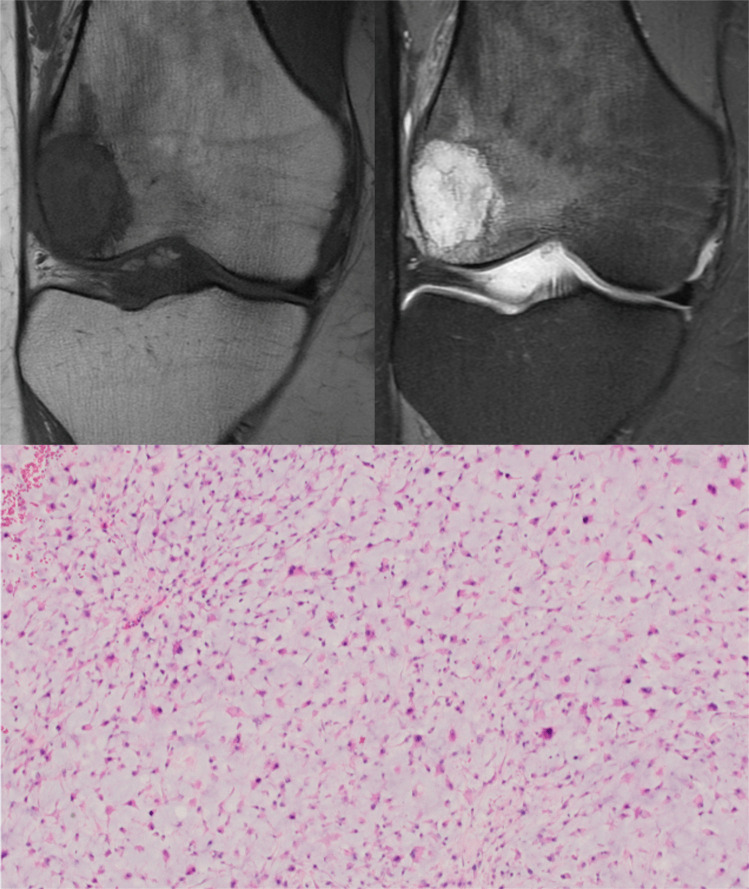 Resonancia e histología de un condrosarcoma central grado 2 de la rodilla.