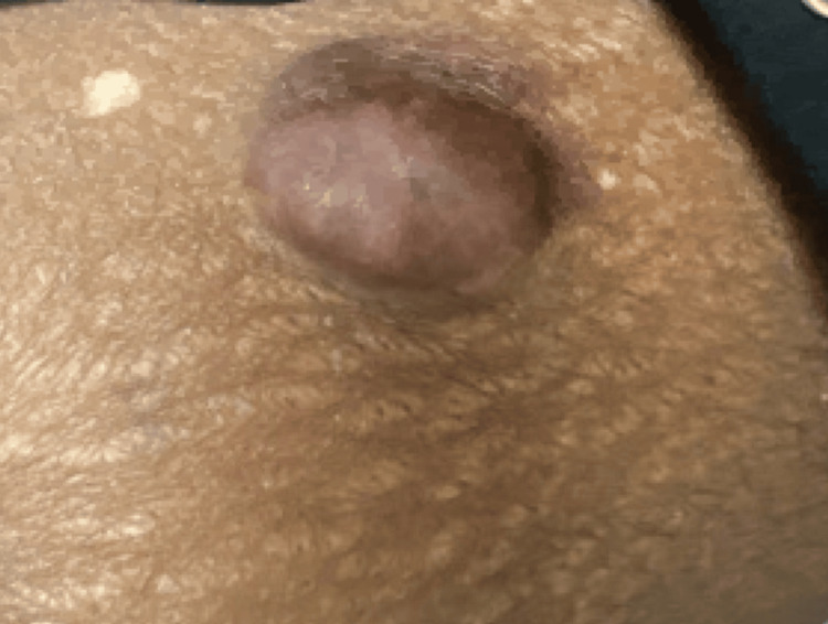 Fotografía clínica de un dermatofibrosarcoma protuberans en la cara anterointerna del muslo.
