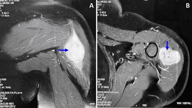 RM del hombro con un tumor desmoide.