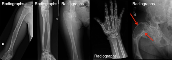 Radiografías de displasia fibrosa en huesos largos, con el signo del reborde esclerótico.