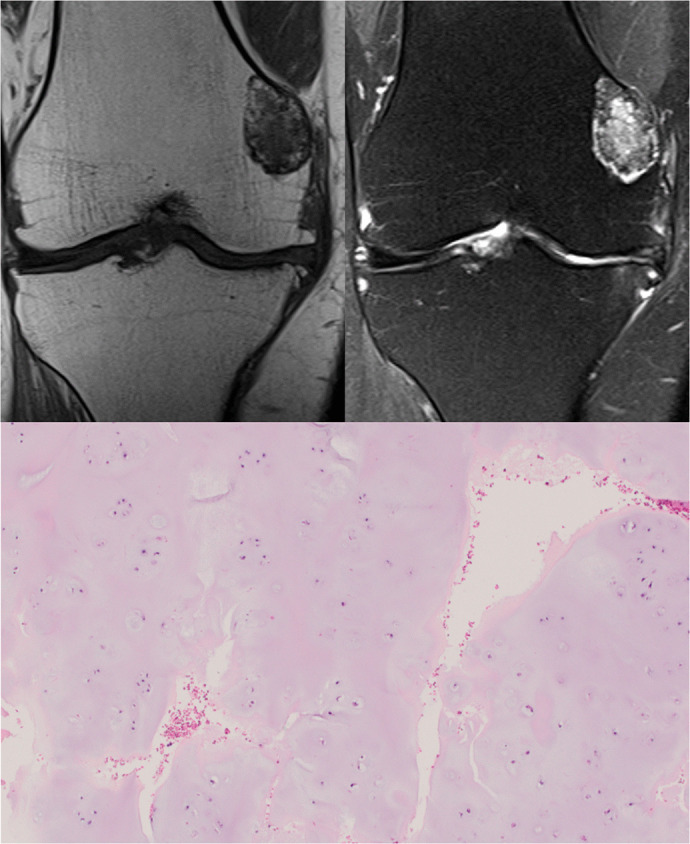 Resonancia e histología de un encondroma metaepifisario en la rodilla.
