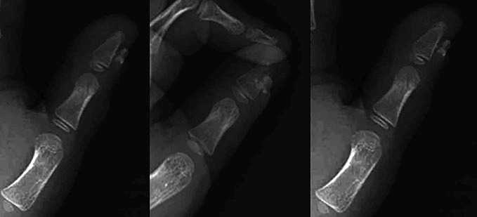 Radiografías del pulgar con una calcificación sobre la falange distal.
