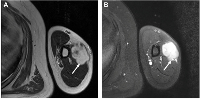 Fascitis nodular intramuscular del brazo en RM axial