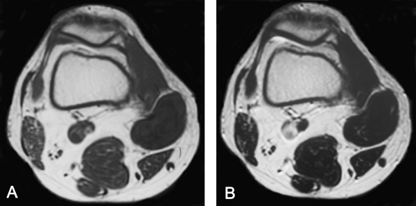 RM del muslo con un fibroblastoma desmoplásico.