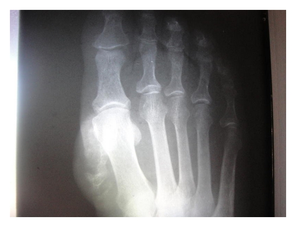 Radiografía del pie con calcificaciones de un fibroma aponeurótico calcificante.