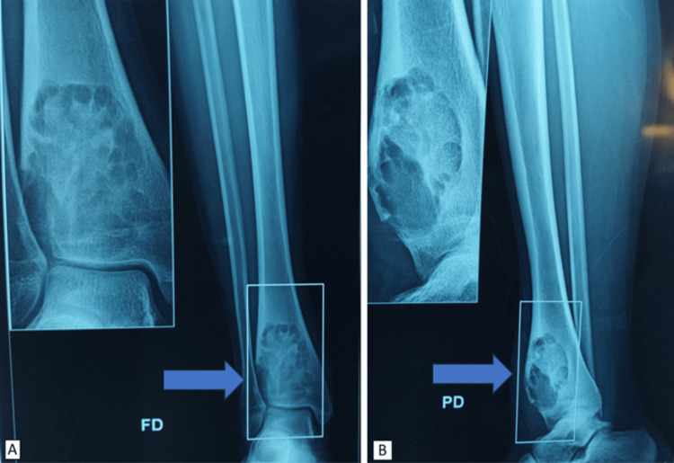 Fibroma condromixoide de la tibia distal en radiografía