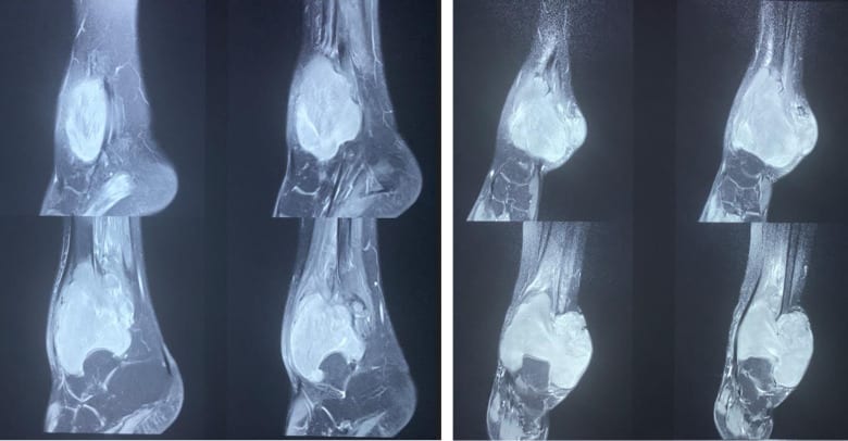 Resonancia de tobillo con una masa lobulada bien delimitada en la metáfisis y la epífisis distal de la tibia y el maléolo externo.