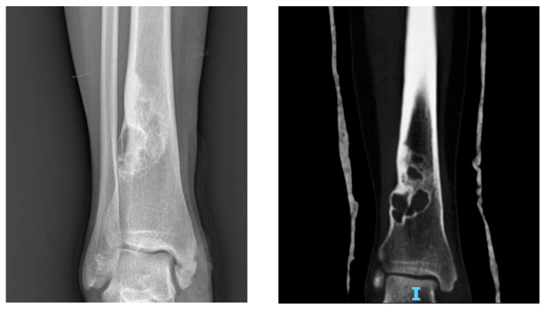 Radiografía y TAC de un fibroma no osificante en la metáfisis distal de la tibia.