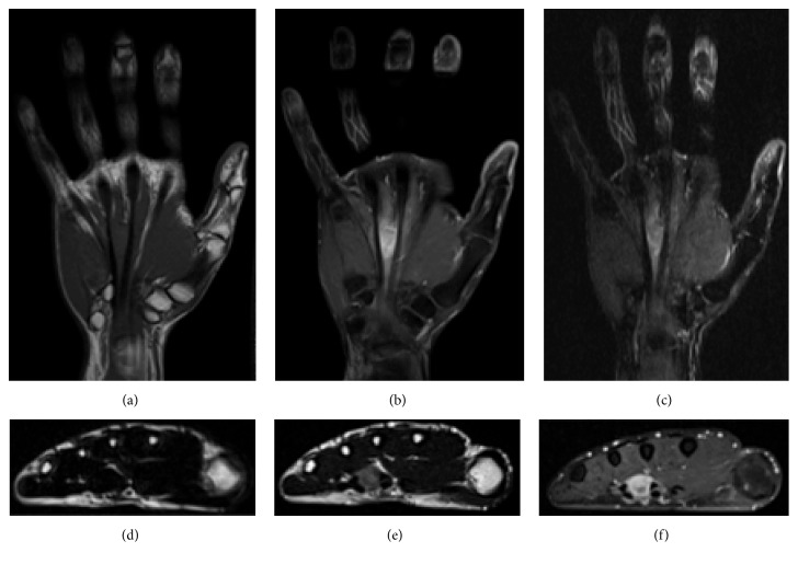 Fibroma de vaina tendinosa de la mano en RM