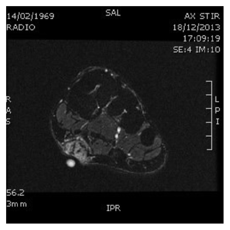 Resonancia del pie con fibromatosis plantar (enfermedad de Ledderhose).