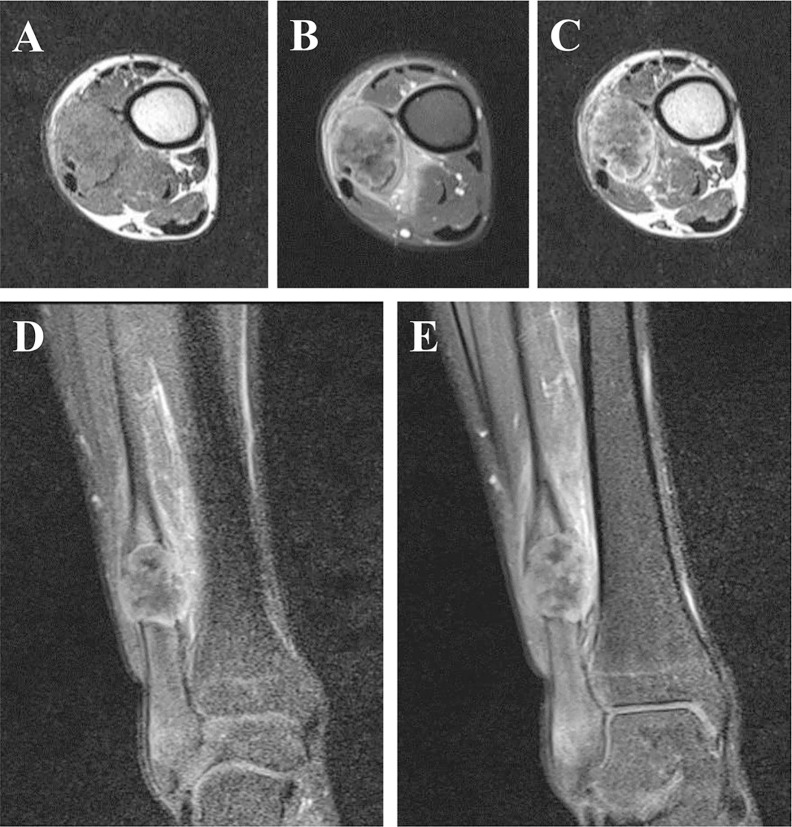 Fibrosarcoma epitelioide esclerosante de la pierna en RM