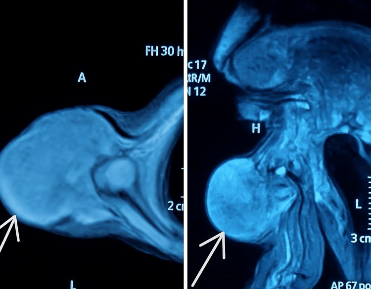 Fibrosarcoma infantil del brazo en RM