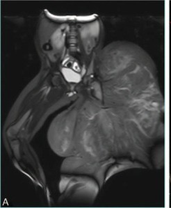 Hamartoma fibroso de la infancia en RM
