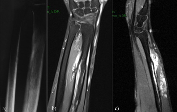 Hemangioendotelioma epitelioide óseo del antebrazo en radiografía y RM