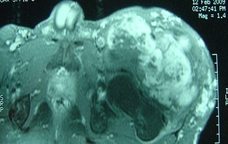 Hemangioendotelioma epitelioide de partes blandas del muslo en RM
