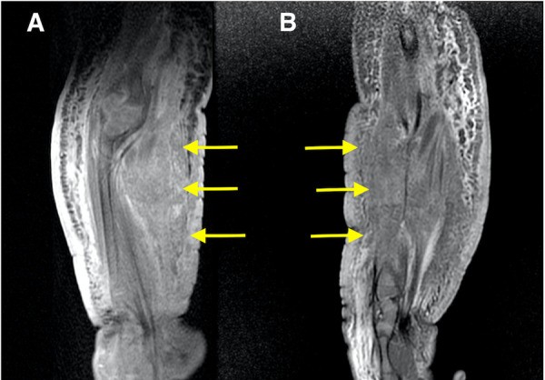 Hemangioendotelioma kaposiforme del antebrazo en RM
