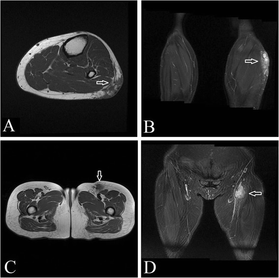 Hemangioendotelioma pseudomiogénico de la extremidad inferior en RM