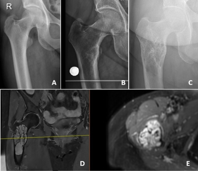 Radiografías y resonancia de un hemangioma epitelioide del fémur proximal, con crecimiento de la lesión a lo largo de diez años.
