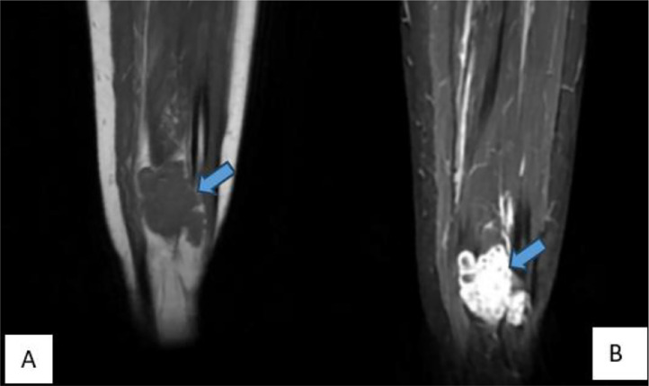 Coronal MRI of the leg, T1 (A) and STIR (B) sequences, with a lobulated intramuscular hemangioma marked by arrows.