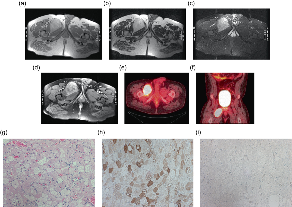 Resonancia y PET de un hibernoma de muslo con histología de grasa parda.