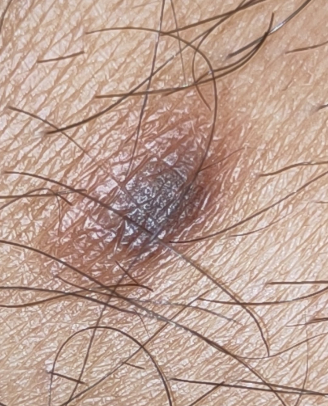 Foto clínica de un dermatofibroma en la pierna.