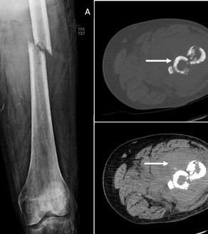 Linfoma primario óseo del fémur en radiografía y TC