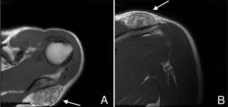 Lipoma de células fusadas del hombro en RM