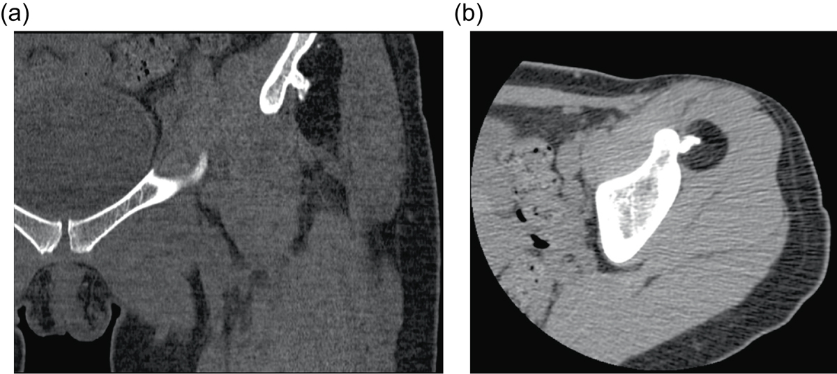 TAC de un lipoma parostal adosado al hueso ilíaco.