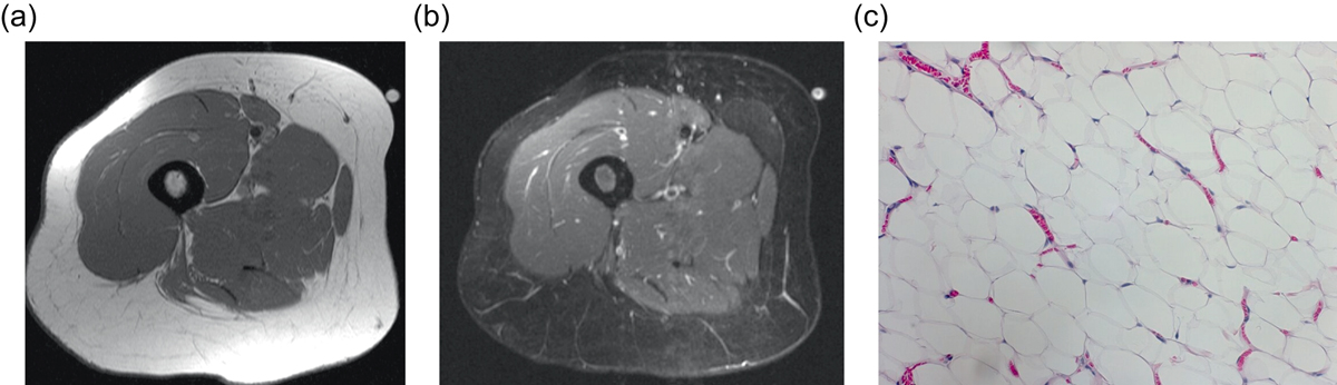 Resonancia (T1 y STIR) e histología de un lipoma simple del muslo.