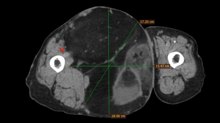 Liposarcoma desdiferenciado del muslo en TC