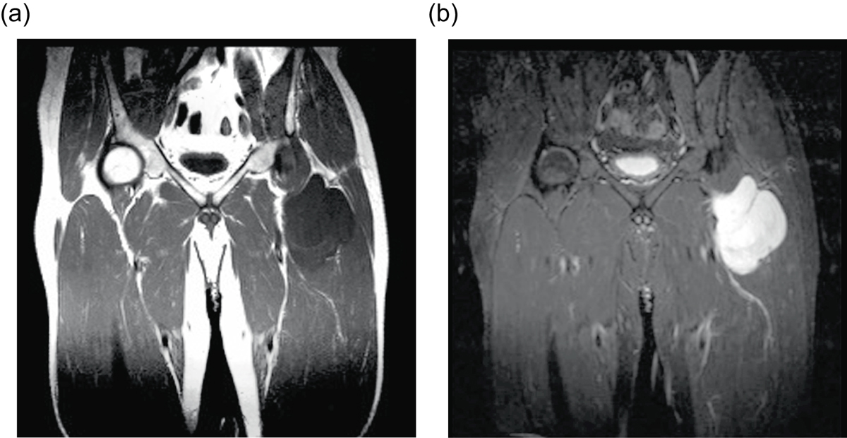 Resonancia de un liposarcoma mixoide con señal baja en T1 y alta en T2.