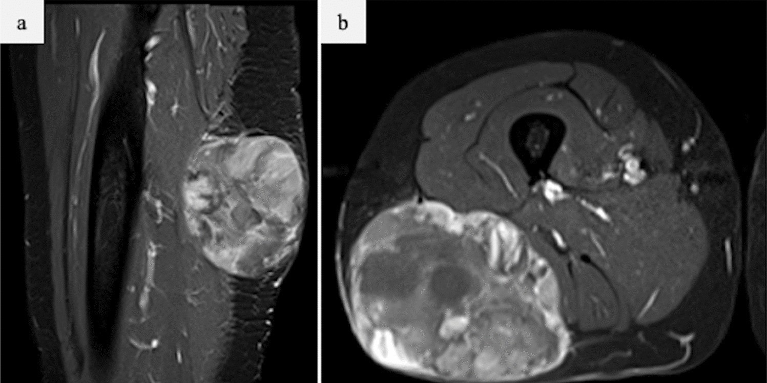 Liposarcoma pleomórfico del muslo en RM