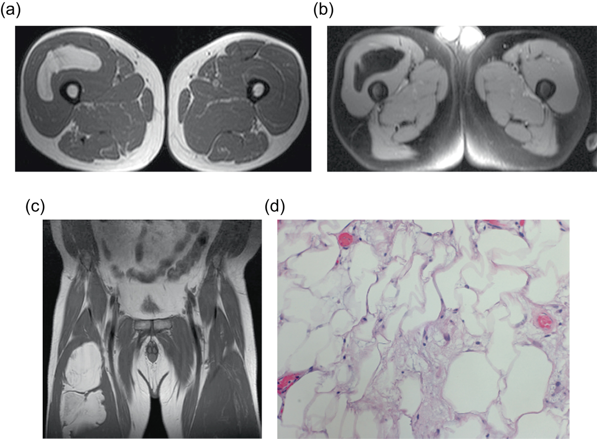 Resonancia (T1 axial y coronal, y DP con supresión grasa) e histología de un liposarcoma bien diferenciado de muslo.