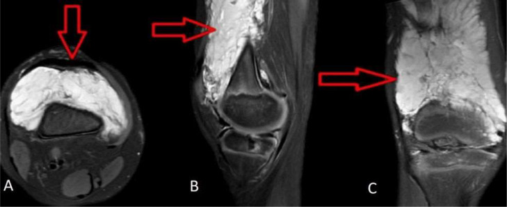 RM de la rodilla con una malformación vascular.