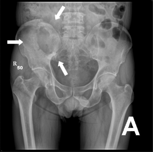 Radiografía de pelvis con una metástasis ósea lítica.